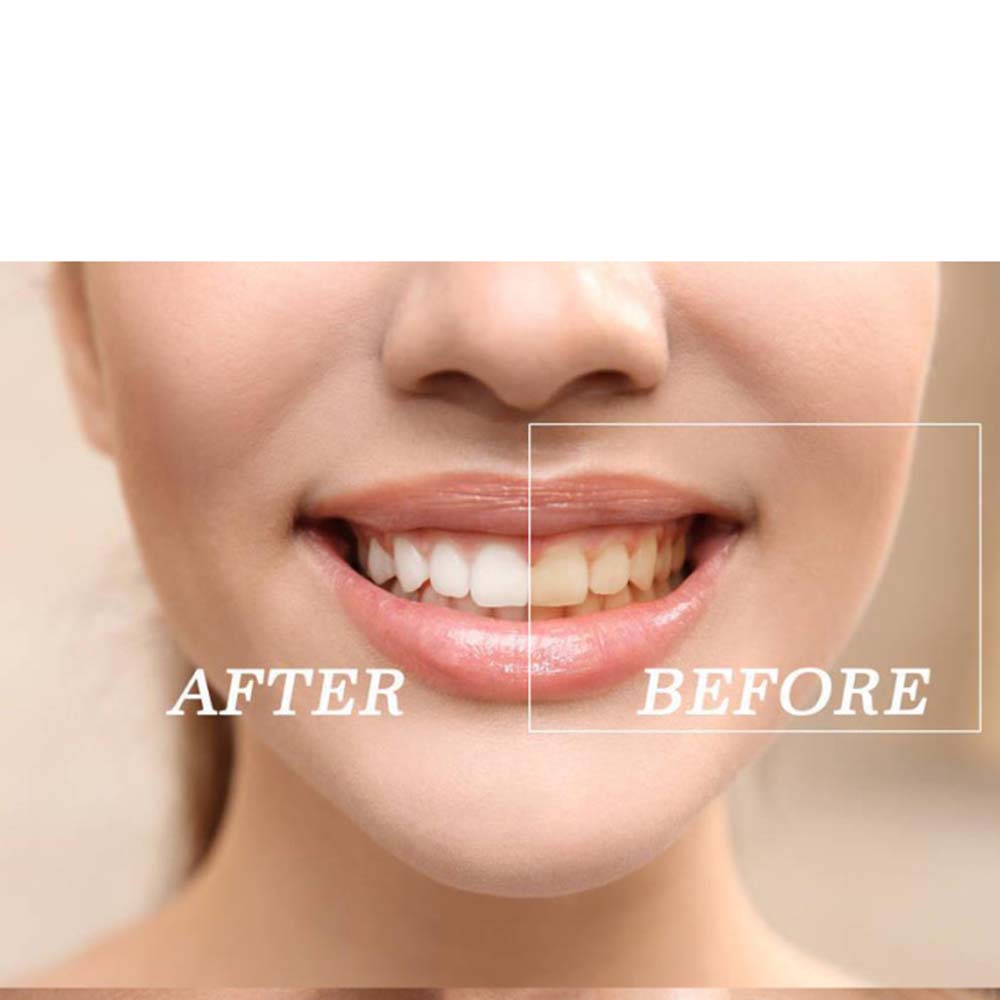 Hochwertiges Peroxid-Zahnaufhe – Teeth Whitening With Peroxide Bewertung und Preis